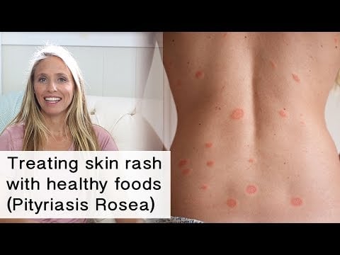 Treating skin rash and inflammation with healthy foods (Pityriasis Rosea)