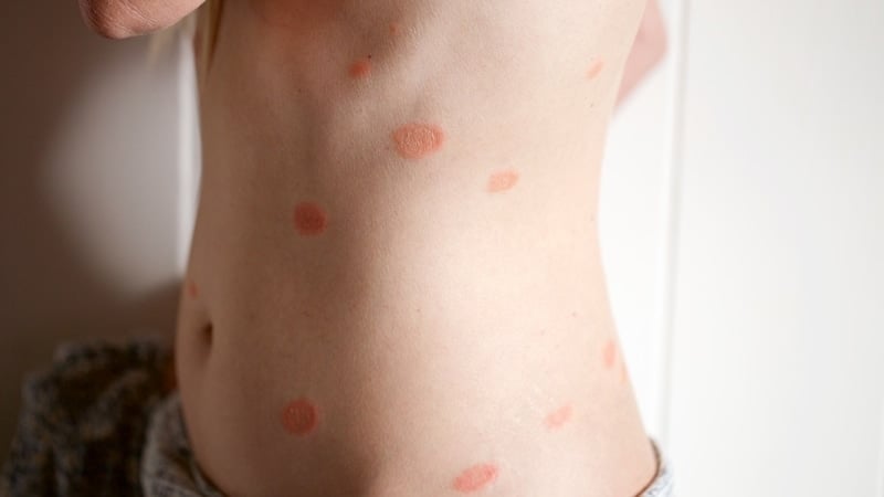 Skin rash knows as pityriasis rosea on the side of Adriana Harlan body
