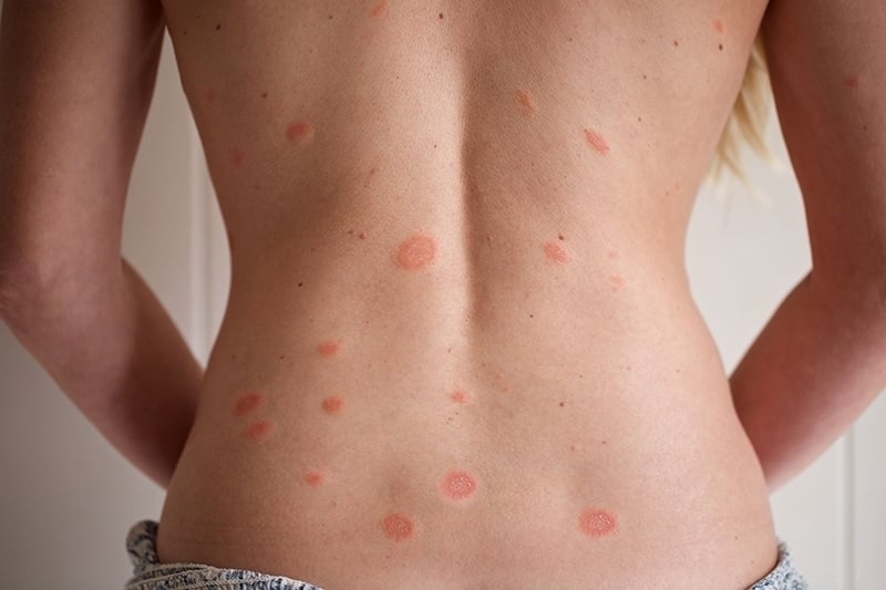Adriana Harlan with Pityriasis Rosea skin rash spots all over her back