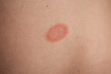 Treating skin rash and inflammation with healthy foods (Pityriasis Rosea)