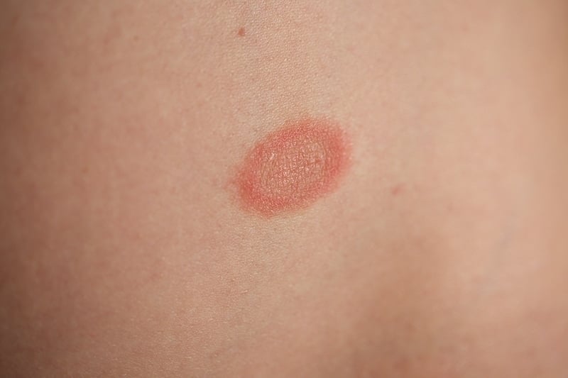 A close up of the skin rash Pityriasis Rosea on the body of Adriana Harlan
