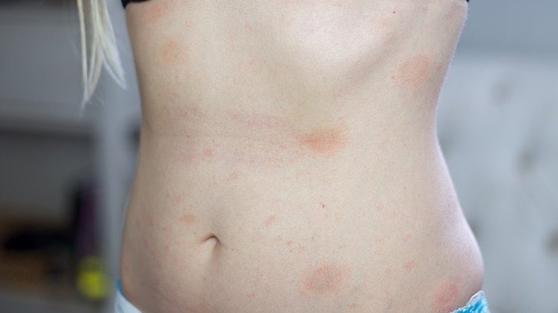 Pityriasis Rosea on the stomach area of Adriana Harlan